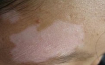 常见中老年人患白癜风的因素