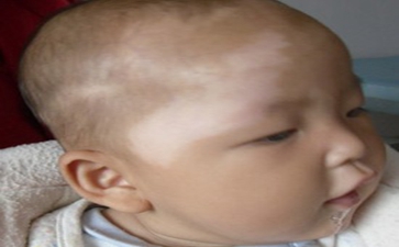 儿童白癜风该怎样治疗