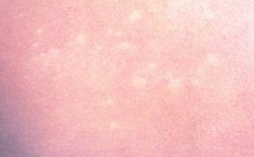 青少年白癜风怎么治疗效果好