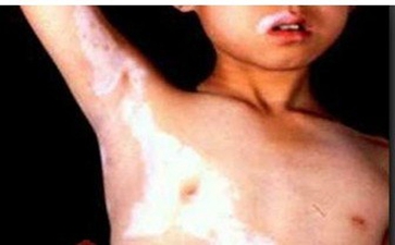 白癜风偏方治疗有哪些