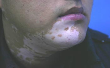 白癜风的生活调理