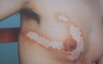 白癜风遮盖液副作用有哪些