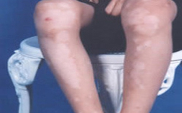 白癜风病情变化的诊断方法