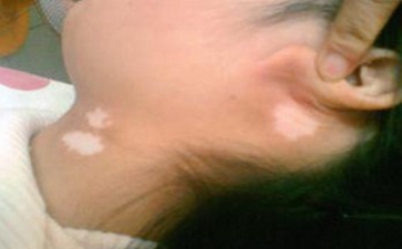 治疗白癜风见效快的方法有哪几种