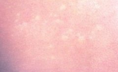 面部白癜风扩散有哪些因素