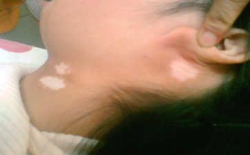 日常生活中要怎么护理白癜风