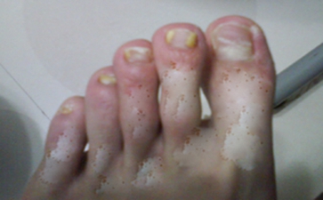 女性白癜风危害有哪些表现