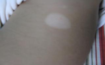 成人白癜风形成的因素有哪些