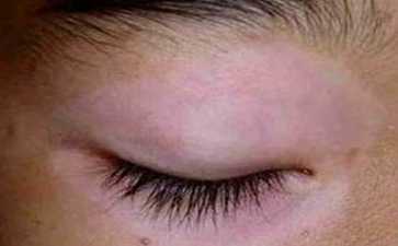 白癜风的日常偏方都有哪些