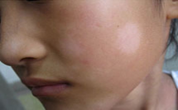 中老年人为什么容易患上白癜风