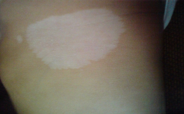 散发型白癜风该怎么治疗