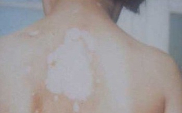 肢端型白癜风怎么治疗