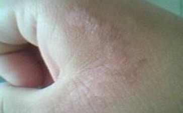 女性白癜风怎么治好