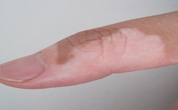 青少年白癜风怎么护理肌肤