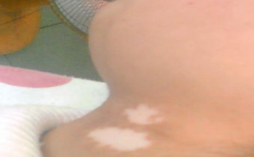 白癜风常用民间偏方有哪些