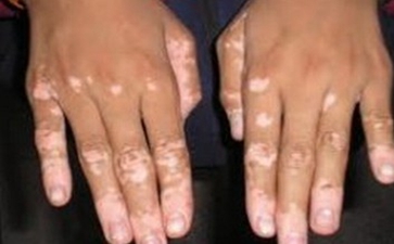 白癜风遮盖液的危害有哪些