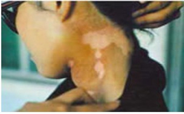 中老年人患白癜风的原因是什么