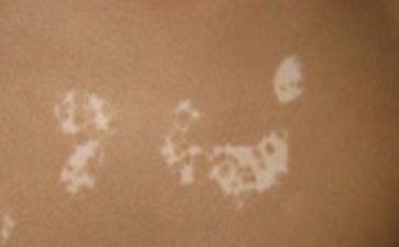 白癜风的护理该怎么做