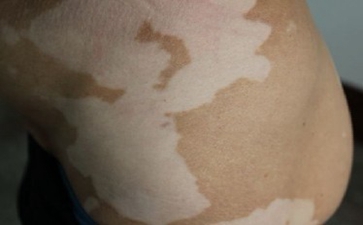 散发型白癜风的危害有哪些