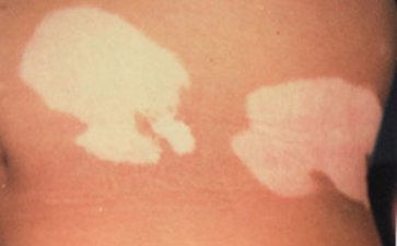 泛发型白癜风能治好吗