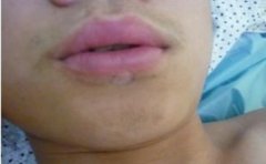 肢端型白癜风的危害都有哪些