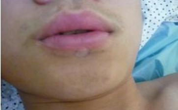 肢端型白癜风的危害都有哪些