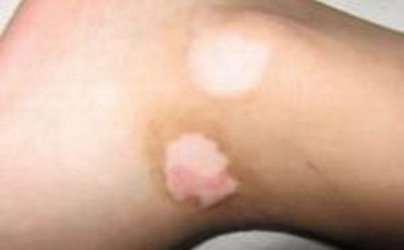 儿童白癜风预防方法有哪些