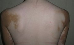 白癜风的偏方秘方有哪些