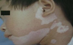 白癜风发作有什么危害