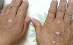 男性白癜风怎么治疗比较好