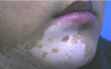 白癜风病症状有哪些