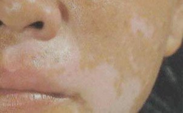 怎么判断白癜风的发病