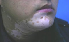 白癜风的护理方法究竟有哪些