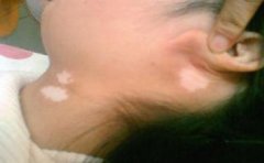 中老年人怎样治疗白癜风