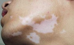 白癜风的保健方法有哪些