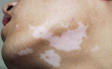 白癜风的保健方法有哪些