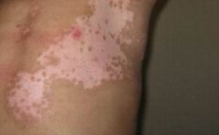 局限性白癜风有哪些治疗方法