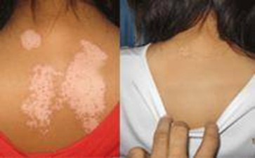 散发型白癜风的护理方法