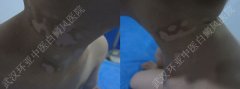 小孩5岁颈部出现多片点状白斑