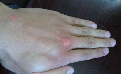 武汉白癜风早期如何治愈?