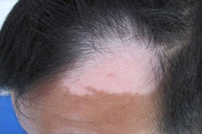 8.2白癜风防治日:科学认知,理性防治