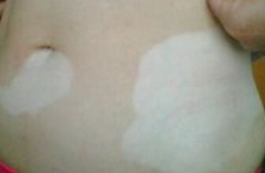 武汉白斑环亚特约