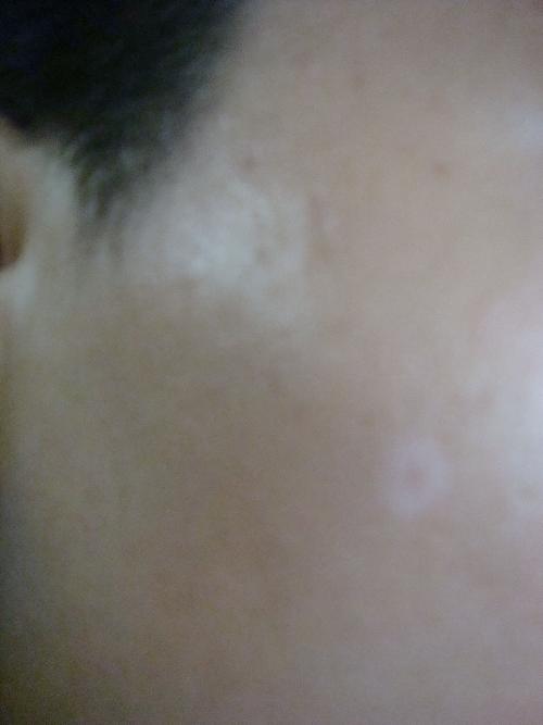 武汉医院看白环亚声名 武汉白颠特临环亚