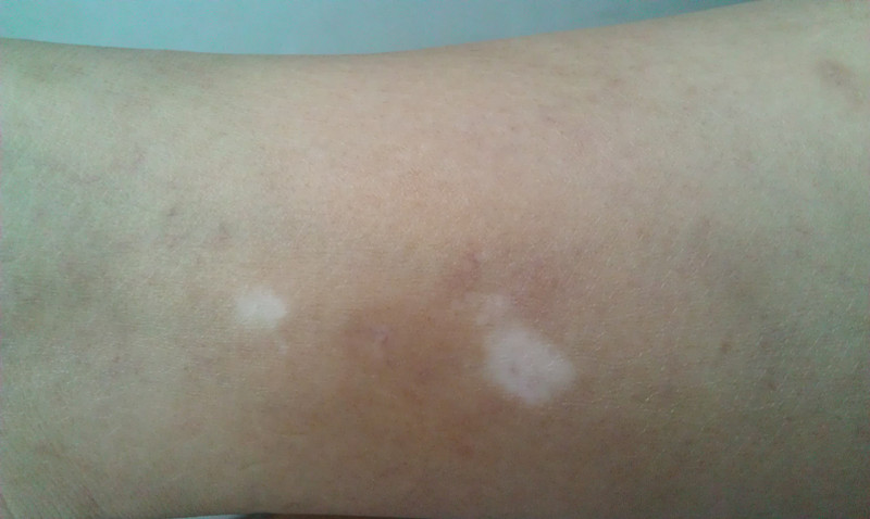 武汉治疗白殿环亚更优秀 武汉环亚白癫